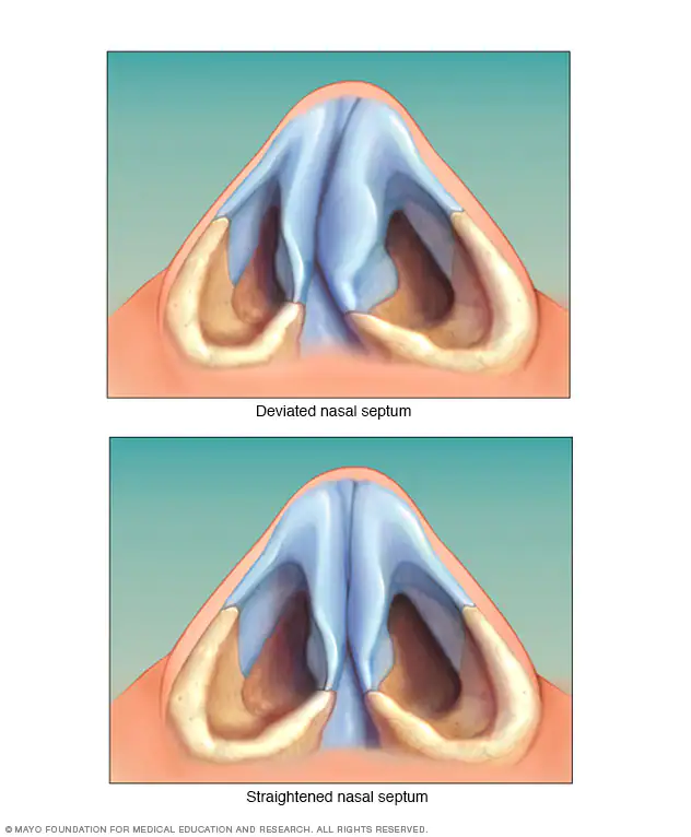 Deviated Nasal Septum Causes & Symptoms - ENT in Cayman
