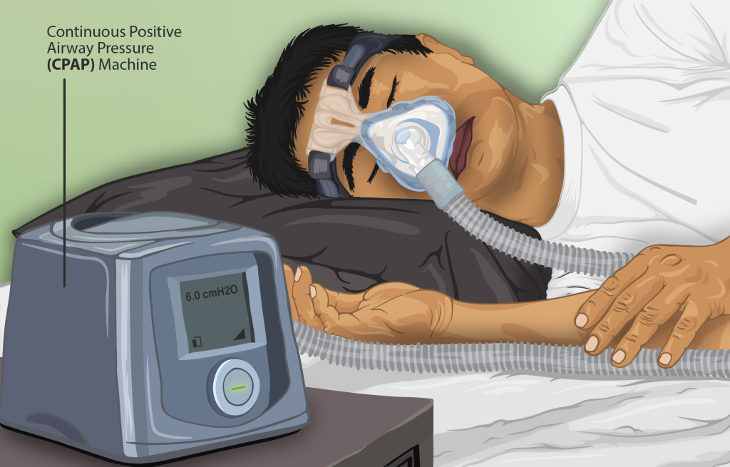 Sleep Apnea Treatment Options